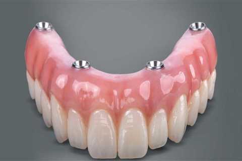 What Materials are Used to Make All-on-Four Dentures?