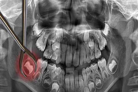 How Long Does It Take to Remove 4 Wisdom Teeth?