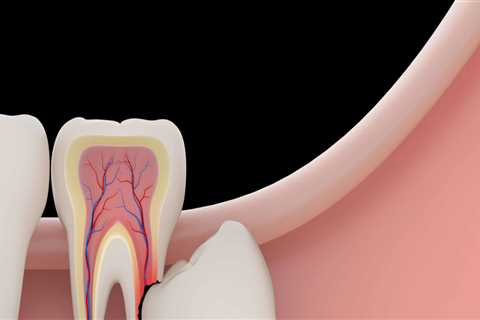 Is Wisdom Tooth Extraction Painful? An Expert's Perspective