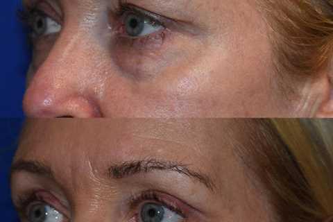 The Seattle Eyelid & Blepharoplasty Center