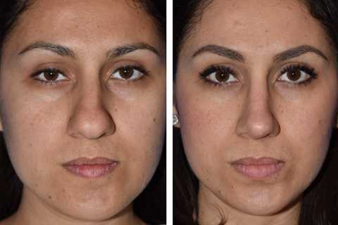 Rhinoplasty Surgery in Edmonds WA