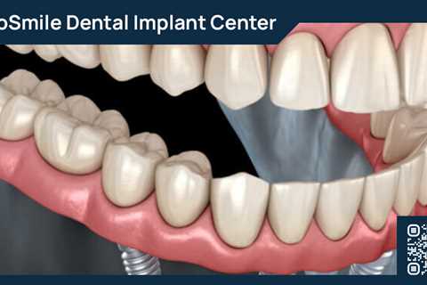 Standard post published to ProSmile Dental Implant Center at May 11, 2023 16:00
