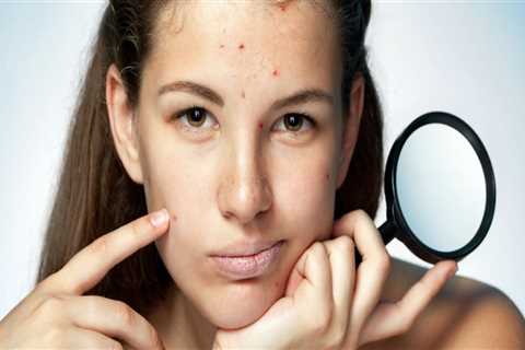 Vitamin A for Acne Treatment: Benefits and How to Use