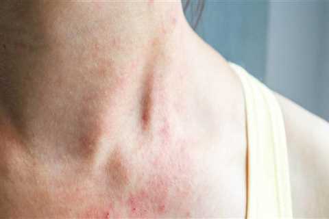 Exploring Rash: Common Symptoms and Treatments