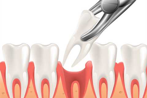 4 Easy Facts About Tooth Extractions Described