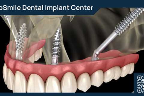 Standard post published to ProSmile Dental Implant Center at May 23, 2023 16:00