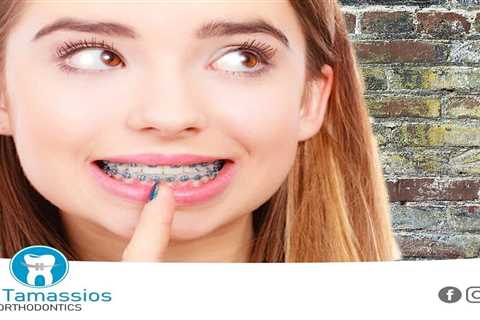 Standard post published to Tamassios Orthodontics - Orthodontist Nicosia, Cyprus at May 28, 2023..