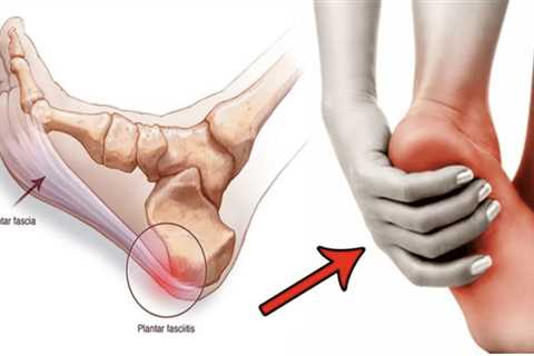 Understanding Plantar Fasciitis: Causes, Symptoms, and Treatment