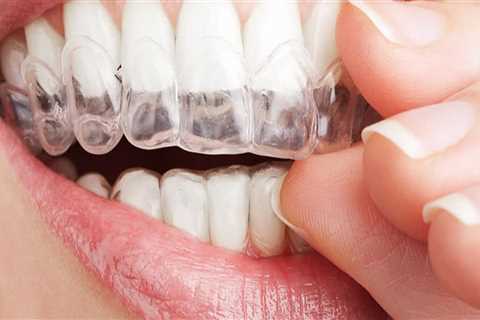 How Much Does Invisalign Cost? A Comprehensive Guide to Understanding the Cost of Orthodontic..