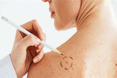 Chemical Treatments for Skin Tag Removal