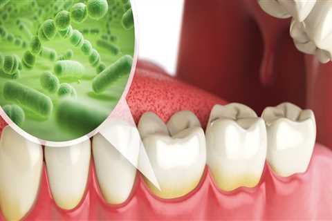 What is the cause of most oral disease?