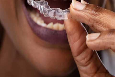 How Spark Aligners Can Complement And Enhance The Results Of Aesthetic Surgery In London