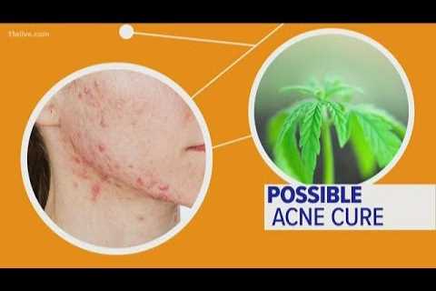 Can CBD oil really help with acne?
