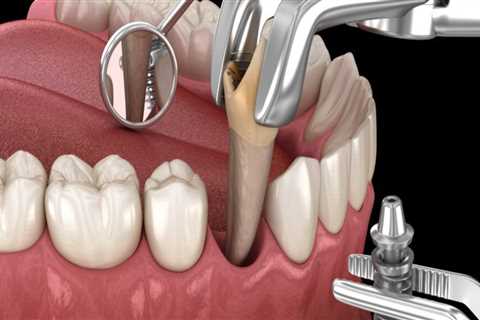 Should you get an implant after extraction?