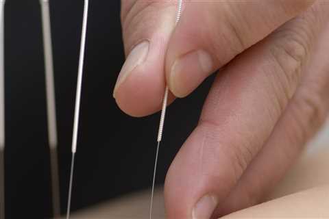 What is Acupuncture and How Does it Work?