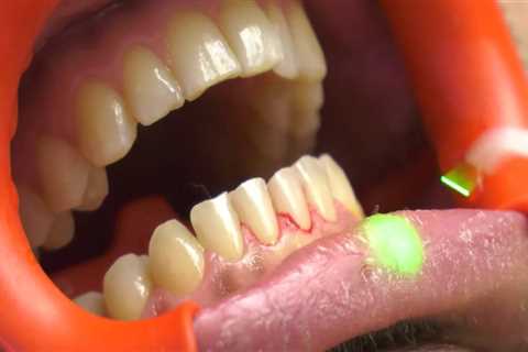 What is laser dental cleaning?