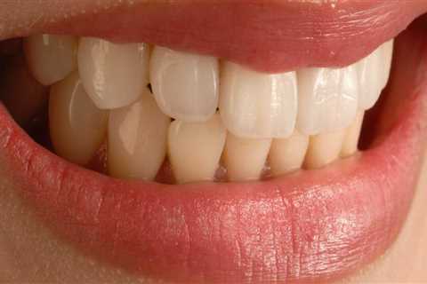 Can veneers cause problems?