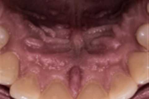 Hard palate