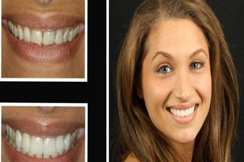 A Comprehensive Guide to Smile Makeovers