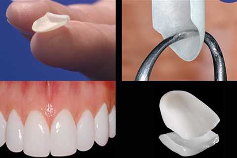 Enhance Your Appearance With Porcelain Veneers: The Ultimate Smile Makeover In Round Rock