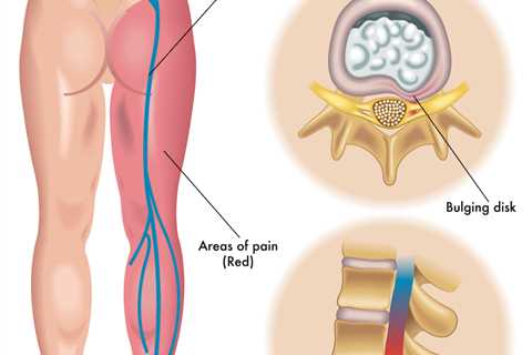 Sciatica Trigger Points | Can Treating Them Help?