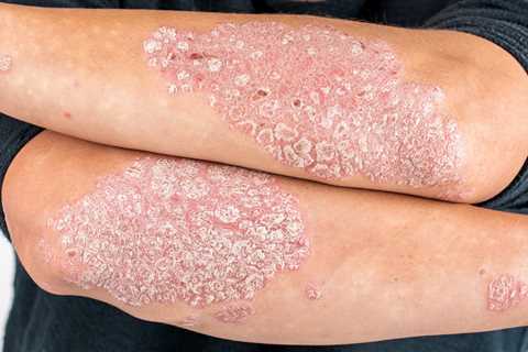 Psoriasis and Diabetes: What’s the Connection?