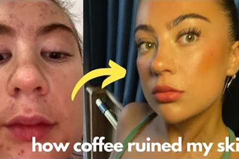 so COFFEE causes ACNE?! - how im clearing my skin