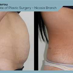 Standard post published to Dr. Demetris Stavrou - European Institute of Plastic Surgery - Nicosia..