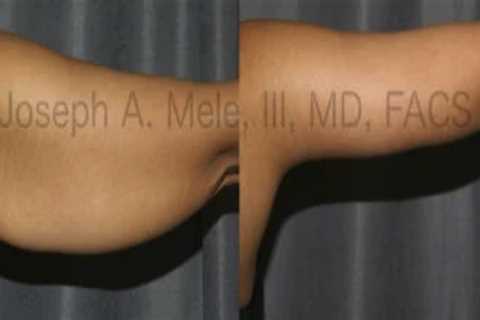 Arm Lift Indications and Brachioplasty Techniques