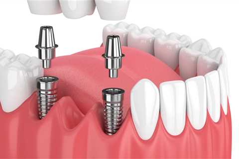 How are dental implants done step by step?