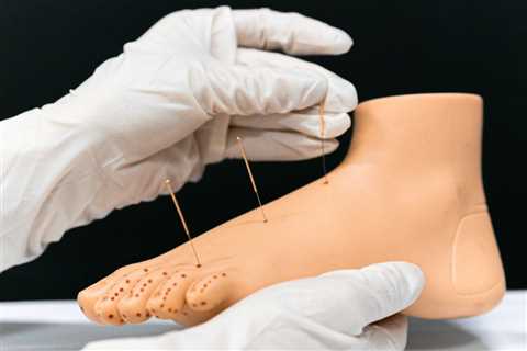 HOW TO USE ACUPUNCTURE FOR FOOT PAIN RELIEF | Family Law Attorney Utah