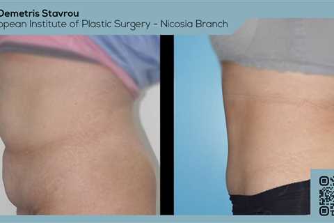 Standard post published to Dr. Demetris Stavrou - European Institute of Plastic Surgery - Nicosia..