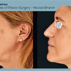 Standard post published to Dr. Demetris Stavrou - European Institute of Plastic Surgery - Nicosia..