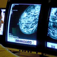 Over 1,400 Women Miss Life-Saving Breast Cancer Checks Due to NHS Error