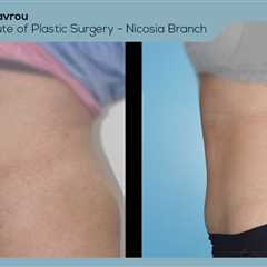 Standard post published to Dr. Demetris Stavrou - European Institute of Plastic Surgery - Nicosia..