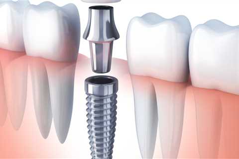 What You Need To Know About Dental Implants In Borger