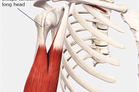 An Inside Look at Bicipital Tendinopathy