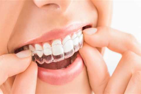 Smile Transformation Starts Here: How To Choose An Invisalign Dentist In Ashburn, VA