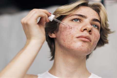 How to Get Rid of Stubborn Pimples Under the Skin