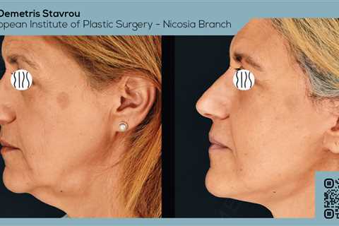 Standard post published to Dr. Demetris Stavrou - European Institute of Plastic Surgery - Nicosia..