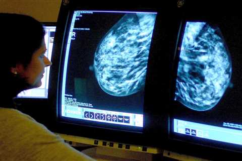 Over 1,400 Women Miss Life-Saving Breast Cancer Checks Due to NHS Error