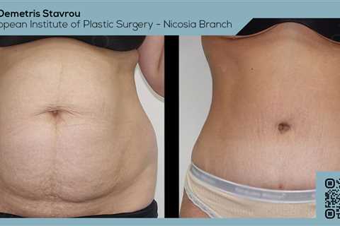 Standard post published to Dr. Demetris Stavrou - European Institute of Plastic Surgery - Nicosia..