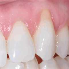 Gum Disease: Symptoms and Care Tips - Best Dental Reviews