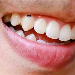 Remove Black Spots from Teeth: Achieve a Bright Smile - Best Dental Reviews