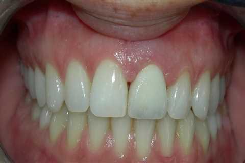 How do you keep veneers from falling off?