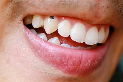 Remove Black Spots from Teeth: Achieve a Bright Smile - Best Dental Reviews
