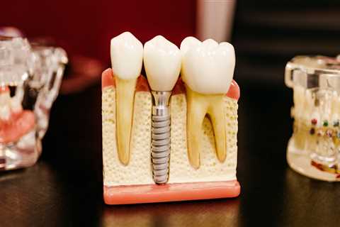 Benefits Of Aftercare For Dental Implants: A Guide From The Best Dentist In Kota Kinabalu