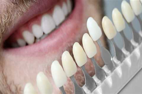 Revamp Your Smile With Dental Veneers And Teeth Whitening In Sydney