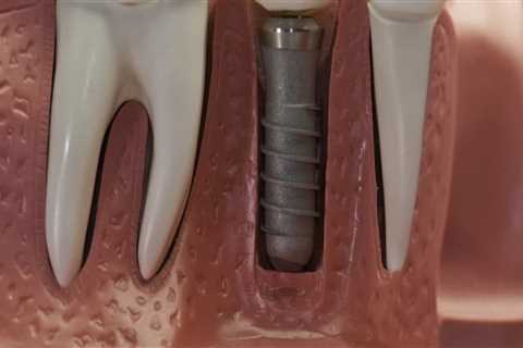 Are dental implants permanent?