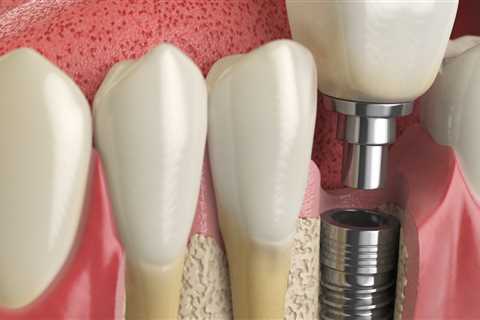 What To Expect When Getting Dental Implants In Ellsworth